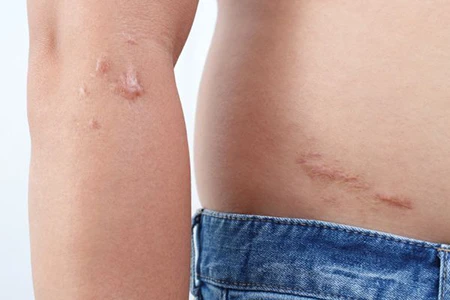 Eliminar adherencias de forma natural